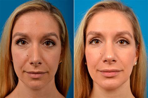 before and after rhinoplasty and chin implant