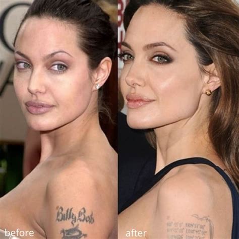 chin augmentation celebrity chin implant