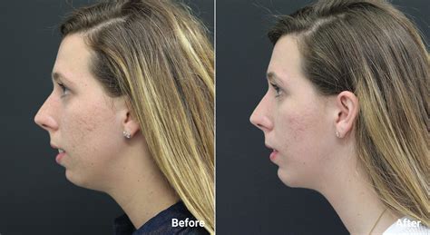 chin implant and nose job before and after