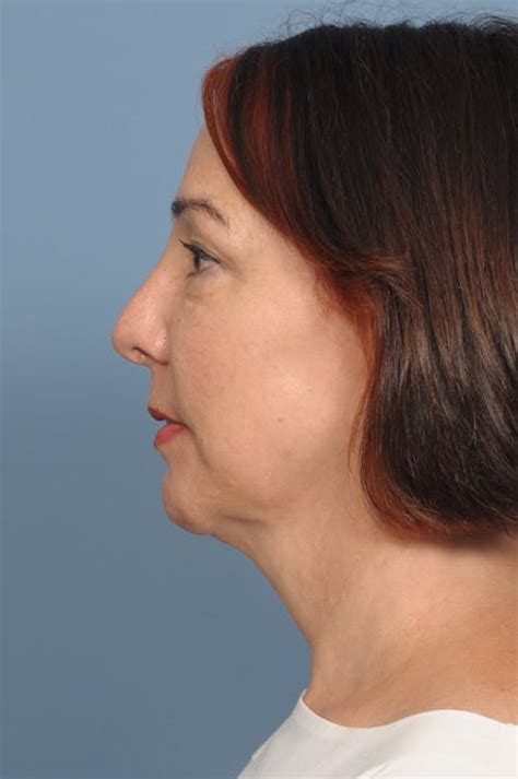 chin implant austin tx