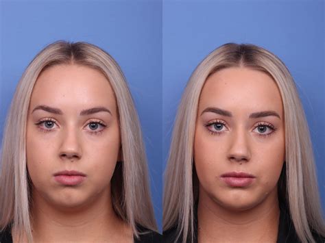 chin implant before and after female