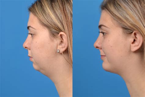 chin implant healing time