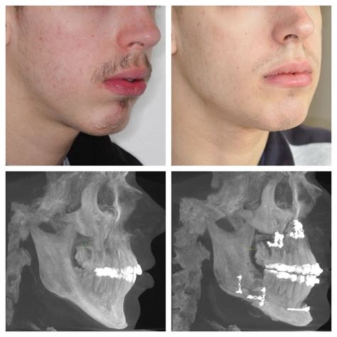 chin wing implant