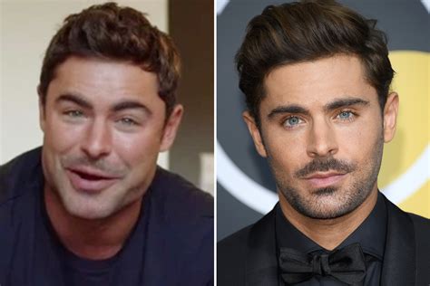 did zac efron get chin implants
