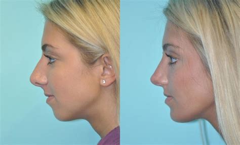 how much is a chin implant surgery