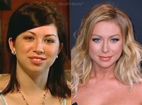 stassi chin implant