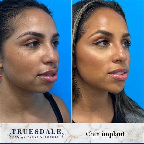 actors with chin implants