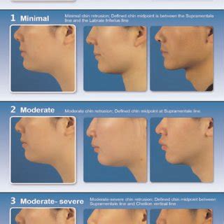 allergan chin implants