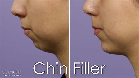 alternative to chin implant