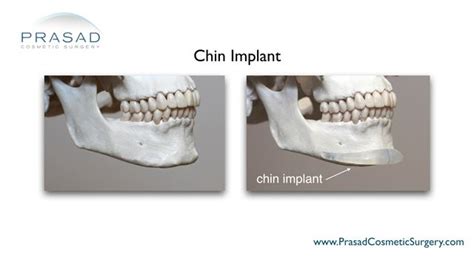 anatomical chin implant