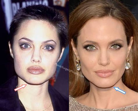 angelina jolie chin implant