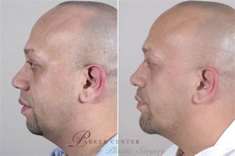 are chin implants dangerous