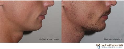 are chin implants permanent