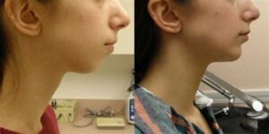 are chin implants worth it reddit