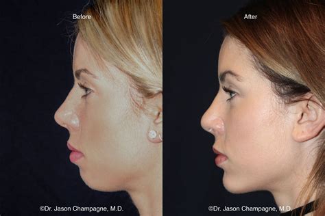 are chin implants worth it