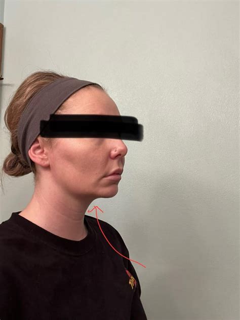 bad chin implant
