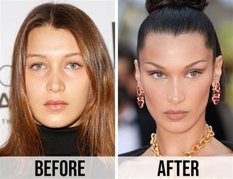 bella hadid chin implant