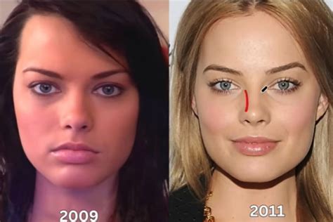 celebrity chin implant scar