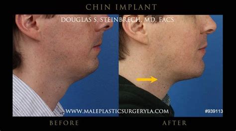chin and jaw implants