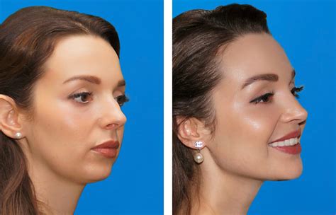 chin cheek implants