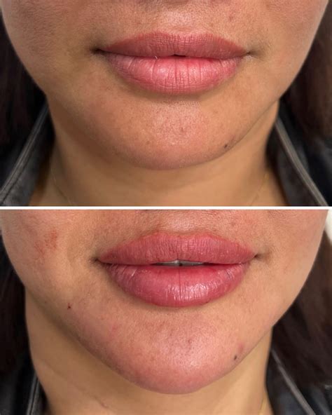 chin filler vs implant