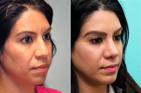 chin implant aftercare