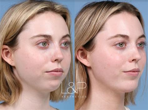 chin implant and buccal fat removal
