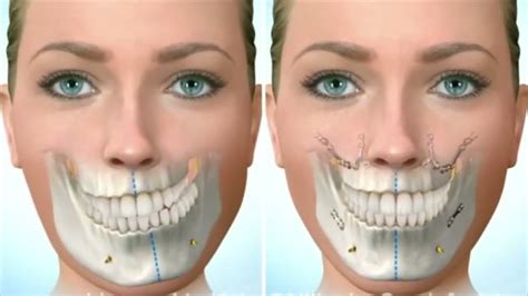 chin implant asymmetry