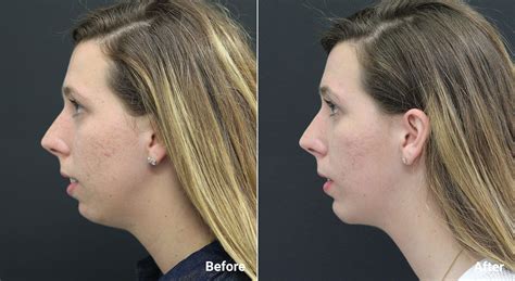 chin implant before after