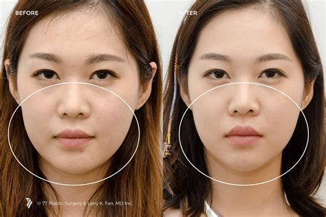 chin implant before and after asian