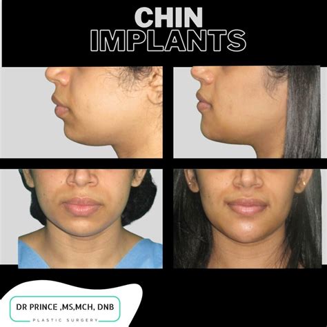chin implant cost near me