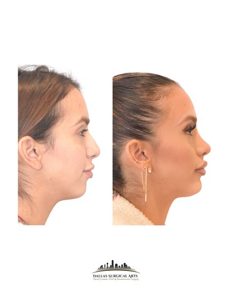 chin implant dallas