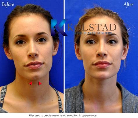 chin implant filler