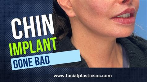 chin implant gone wrong