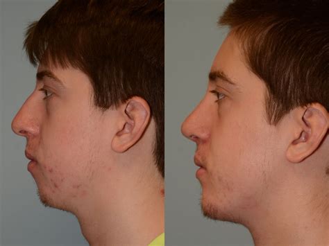 chin implant houston tx