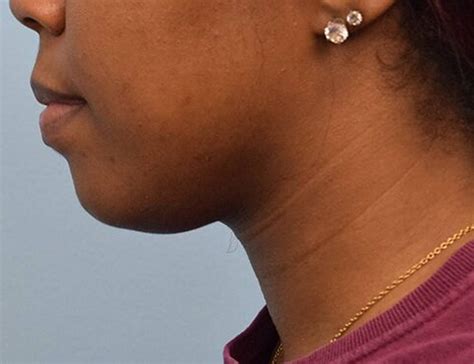 chin implant houston
