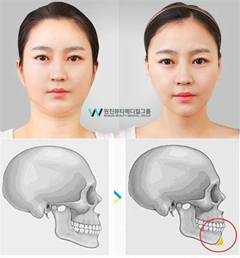 chin implant korea