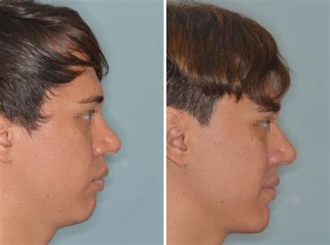 chin implant miami