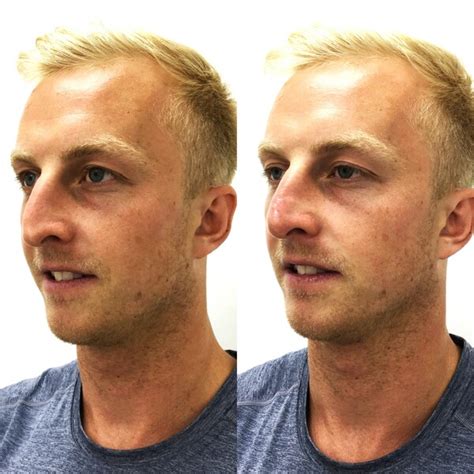 chin implant newport beach
