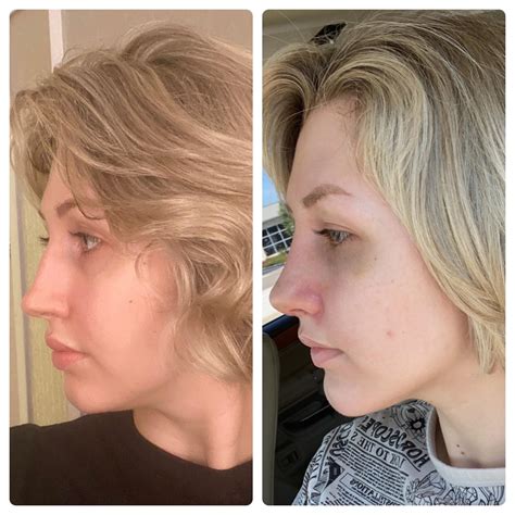 chin implant recovery day by day