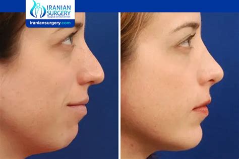 chin implant risks