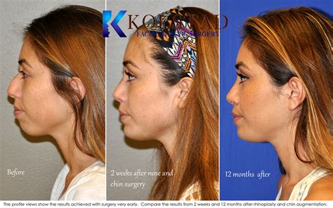 chin implant san diego
