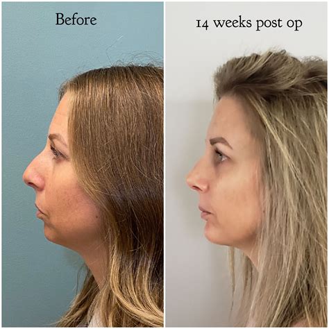 chin implant swelling