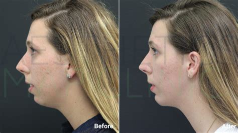 chin implant turkey