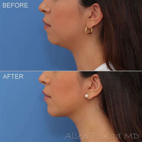 chin implant types
