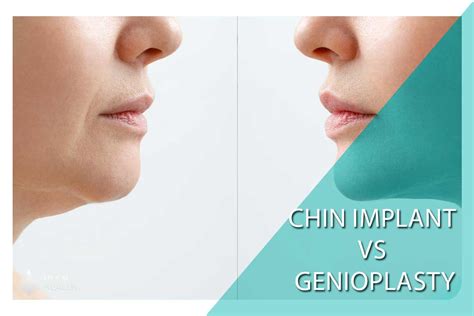 chin implant vs genioplasty