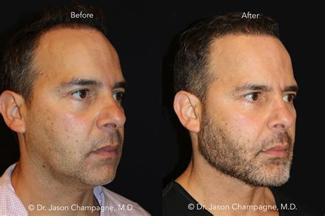 chin implant vs jaw surgery