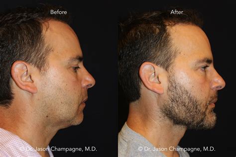 chin implants men