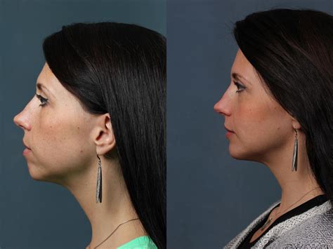 how much is a chin implant