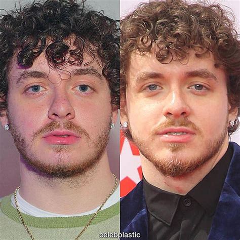 jack harlow chin implants